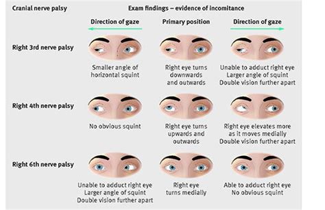 4th Cranial Nerve Palsy Exercises - fingersandfeathersh