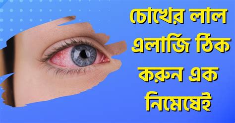 Best Eye Redness Allergy (চোখ ওঠা) Treatment at Home