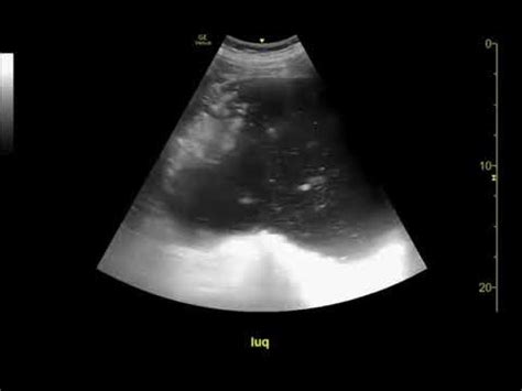 Point-of-care ultrasound of gastric volvulus demonstrating a distended, fluid-filled stomach ...