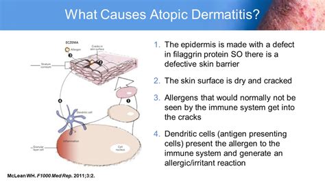 Atopic Dermatitis: Improving Outcomes in Adult and Pediatric Patients ...