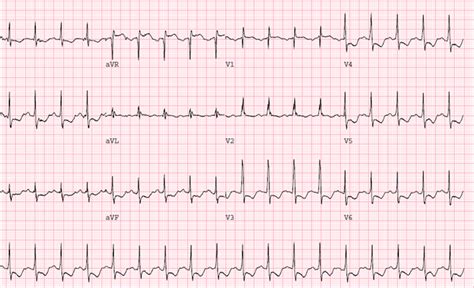 Echocardiogram stress test results revealing polymorphic ventricular... | Download Scientific ...