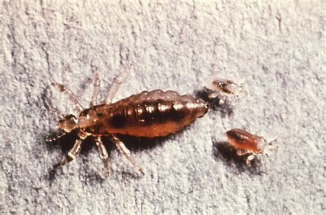 Body Lice | symptoms, diagnosis, treatment, pictures, home remedies