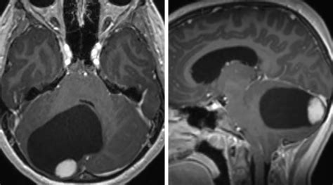 Pilocytic Astrocytoma | The Neurosurgical Atlas