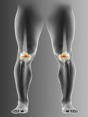 Bilateral Knee Replacement Houston, TX | Bilateral Knee Arthroplasty Cypress, TX