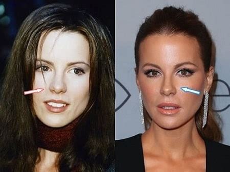 Kate Beckinsale Plastic Surgery Transformation – Before and After ...