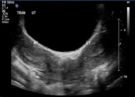 Mullerian Duct Anomalies: Uterine Didelphys | RADIOLOGYPICS.COM