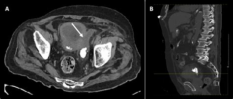 Cureus | A Jackstone Calculus Residing in a Urinary Bladder Diverticulum