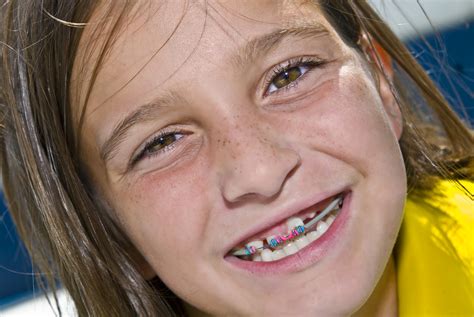 Braces for Kids: What's the Right Age to Start Orthodontia?