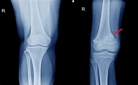 Premium Photo | X-ray knee (ap)views showing normal knee joint and ...