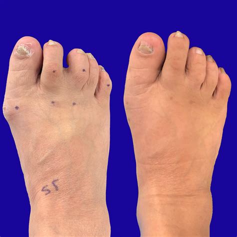 Before and After Bunion Surgery Photos | The Bunion Cure