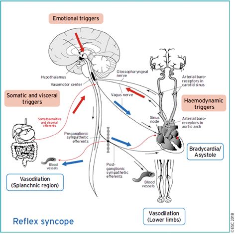 Syncope réflexe : e-cardiogram