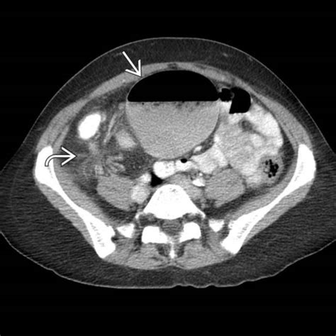 Cecal Volvulus | Radiology Key