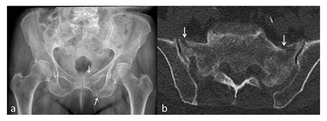 Pubic rami fractures in the elderly – a neglected injury?