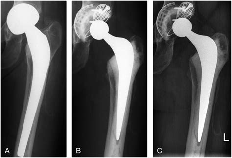 A. A 43-year-old woman at presentation with a loose cemented ...