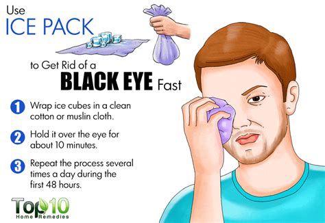 How to Get Rid of a Black Eye Fast | Top 10 Home Remedies