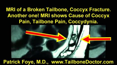 MRI of Broken Tailbone, Coccyx Fracture. See what the Radiologist missed! | Tailbone Doctor