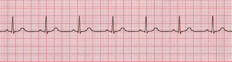 Normal Sinus Rhythm Diagram | Quizlet