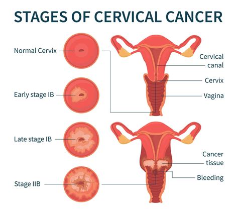 Stages of cervical cancer white infographic scheme 3145603 Vector Art at Vecteezy