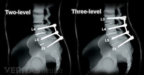 Fusion Definition | Back Pain and Neck Pain Medical Glossary