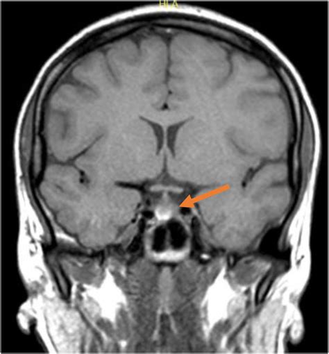 Coronal section of the MRI brain showing a pituitary microadenoma just ...