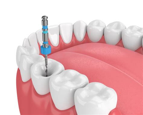 Root Canal (Pain Relief During Recovery And How To Treat It)