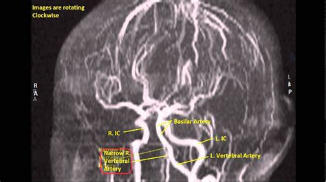 Abnormal Vertebral Artery MR Angiography - Sanjoy Sanyal - YouTube