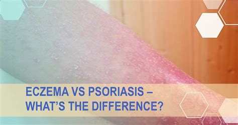 What Is The Difference Between Eczema and Psoriasis | APDerm