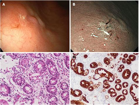 Gastric adenocarcinoma of fundic gland type with signet-ring cell carcinoma component: A case ...