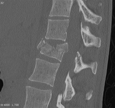 Evidence-based management of traumatic thoracolumbar burst fractures - Neurosurgery Blog