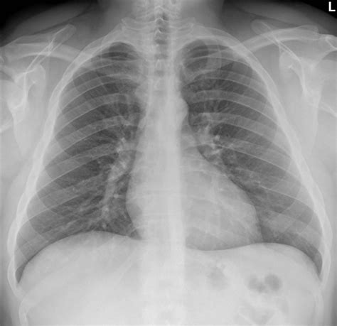 Sternoclavicular Joint Dislocation • LITFL • Trauma library