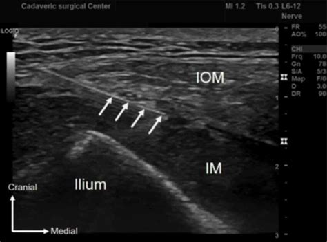 Ultrasound image of the suprainguinal fascia iliaca block. IOM:... | Download Scientific Diagram