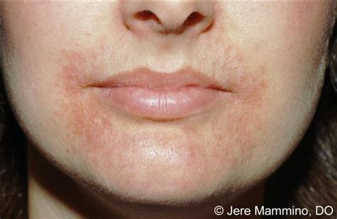 Perioral Dermatitis - American Osteopathic College of Dermatology (AOCD)