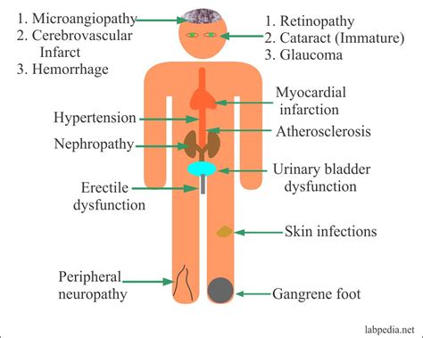 Diabetes Mellitus:- Part 6 – Diabetes Mellitus Complications and Prevention – Labpedia.net