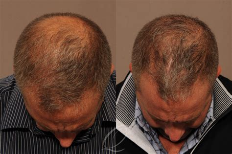 Male FUE Hair Transplant Before and After Pictures Case 1334 | Rochester, Buffalo, & Syracuse ...