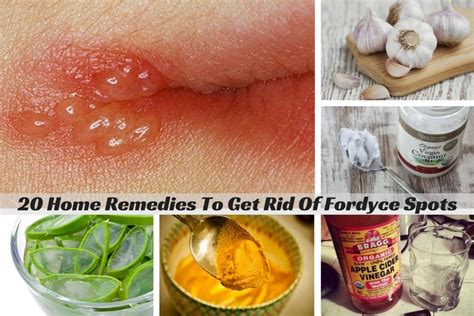 Fordyce Spots On Lips Treatment Apple Cider Vinegar And Honey ...