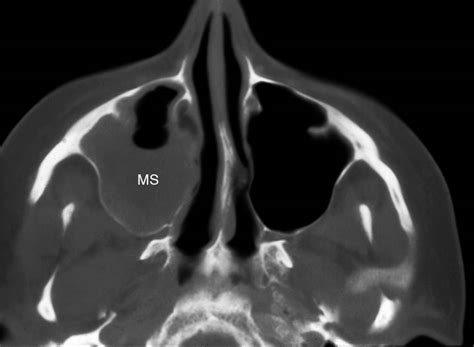 Radiologist For Ever: Paranasal sinuses rule 3 :Causes of sinus ...