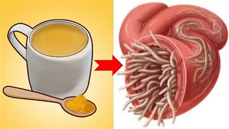 Natural Ways To Get Rid Of Intestinal Worms In No Time - YouTube