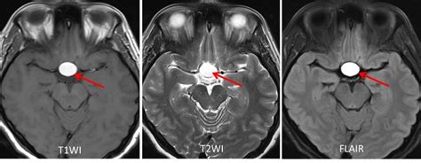 Pituitary apoplexy – Radiology Cases