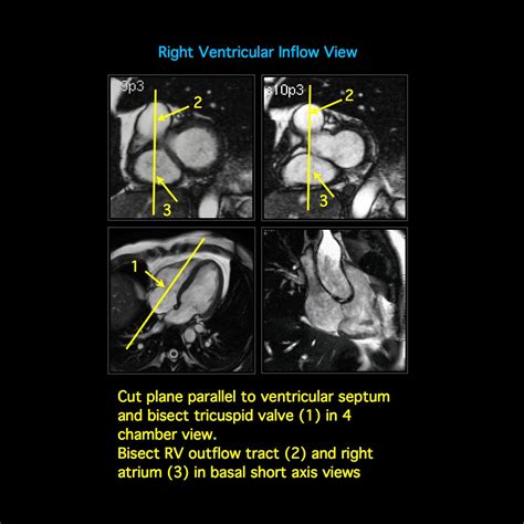 MRI BLOG: Cardiac MRI - Imaging Planes for Basic Cardiac Views