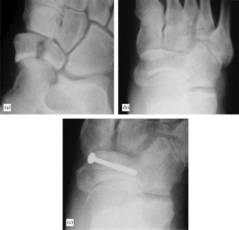 Cuneiform Bone Fracture