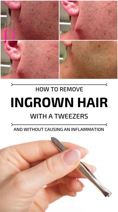 How To Remove Ingrown Hair With A Tweezers And Without Causing An Inflammation - My Beauty Tips ...