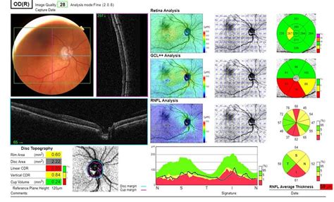 OPTOMETRY: Normal-tension glaucoma | ProFile – Specsavers journal