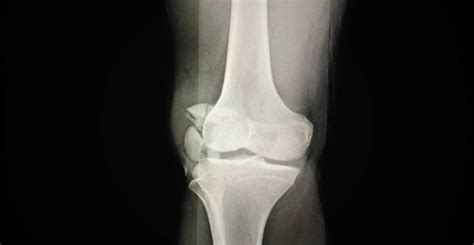 Patella Fracture - Plymouth Bay Orthopedic Associates, Inc.