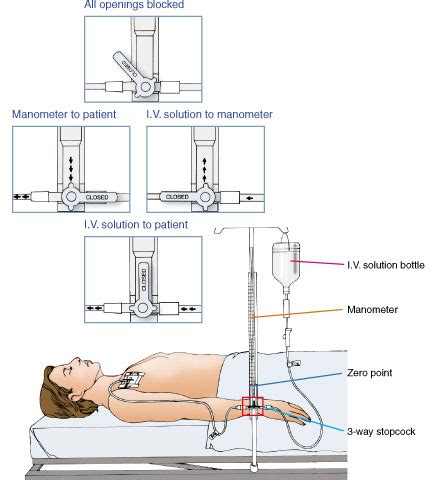 Central Venous Pressure; Venous Pressure, Central