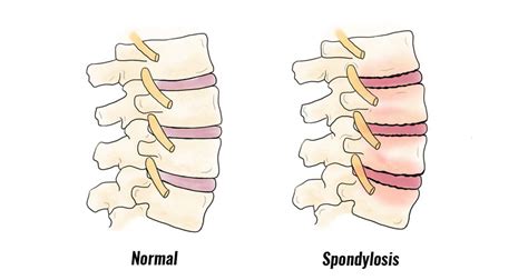 Lumbar Spondylosis Symptoms