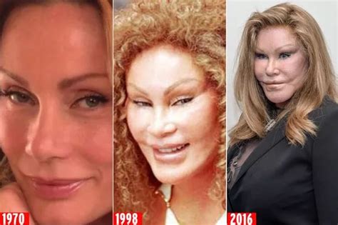 Celebrities who went too far with plastic surgery/fillers? | Page 5 ...