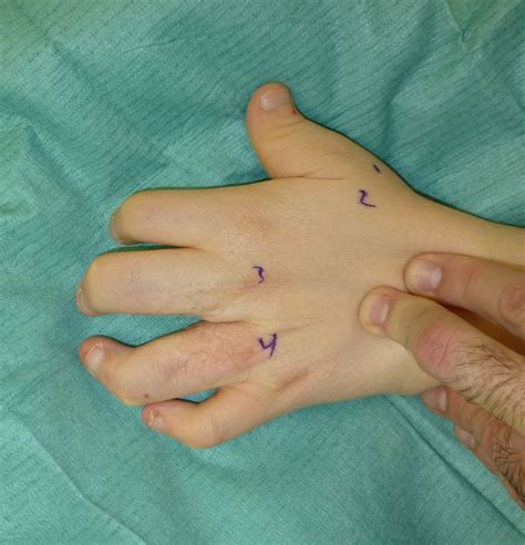 Carpenter Syndrome | Congenital Hand and Arm Differences