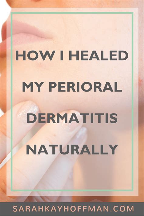 How I Healed My Perioral Dermatitis Naturally - A Gutsy Girl® | Perioral dermatitis, Perioral ...