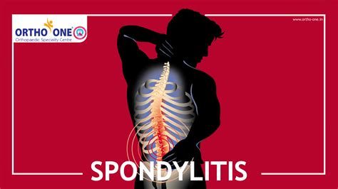 Spondylitis - Ortho One