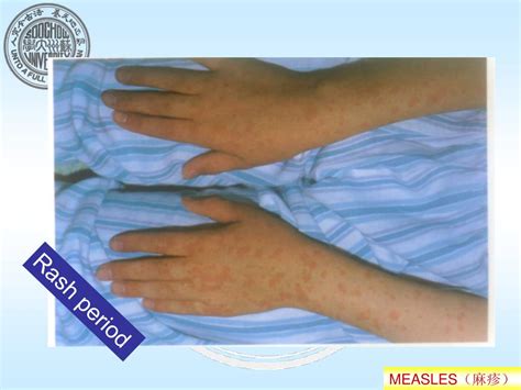 PPT - MEASLES (RUBEOLA) PowerPoint Presentation, free download - ID:6492882